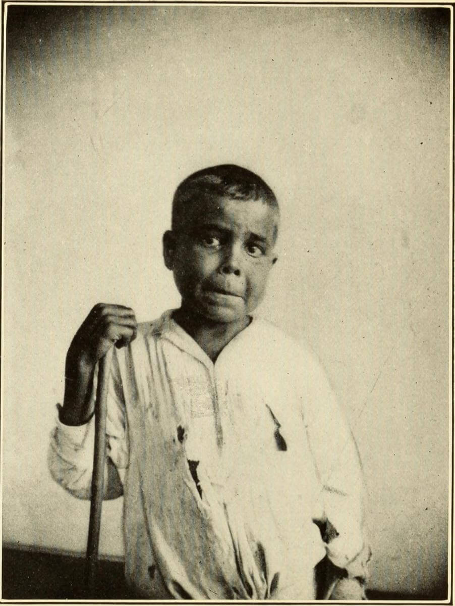 Typical Face, Boy, Puerto Rico, 1911. Originally published in Bailey K. Ashford and Pedro Guitérrez Igaravidez's Uncinariasis (Hookworm disease) in Porto Rico: a medical and economic problem (Washington DC: US Government Print Office, 1911). Courtesy of Wikimedia Commons. Image is in public domain. Typical Face, Boy, Puerto Rico, 1911. Originally published in Bailey K. Ashford and Pedro Guitérrez Igaravidez's Uncinariasis (Hookworm disease) in Porto Rico: a medical and economic problem (Washington DC: US Government Print Office, 1911). Courtesy of Wikimedia Commons. Image is in public domain.