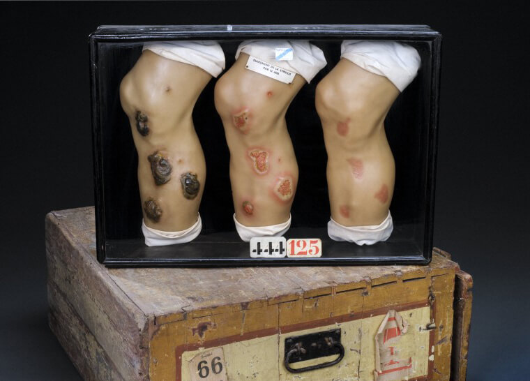 Wax models showing the effects of syphilis symptoms on the extremities before and after Salvarsan, Germany, ca. 1910. Image courtesy of Wellcome Trust Medical Photographic Library. Creative Commons license CC BY 4.0.